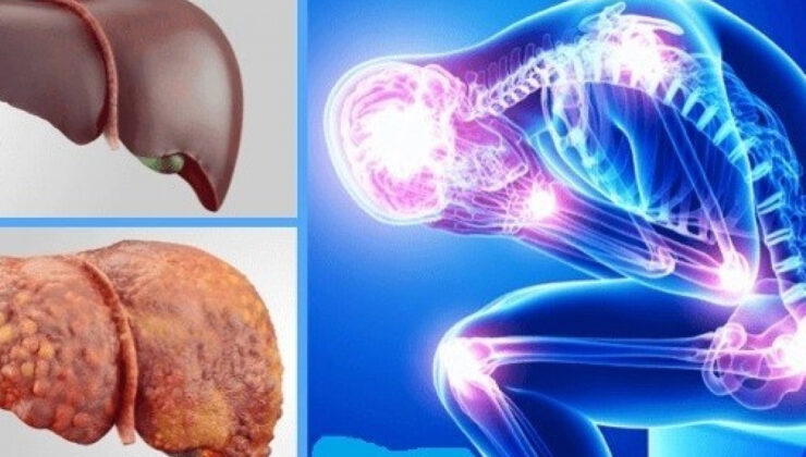 KARACİĞER NAKİLLERİ ARTTI, HASTALIK ÖNLENEBİLİR