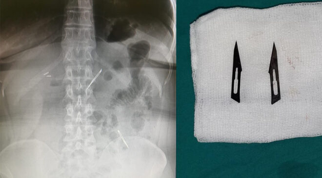 KARIN AĞRISI ŞİKAYETİYLE GİTTİ, 2 TANE NEŞTER YUTTUĞUNU ÖĞRENDİ