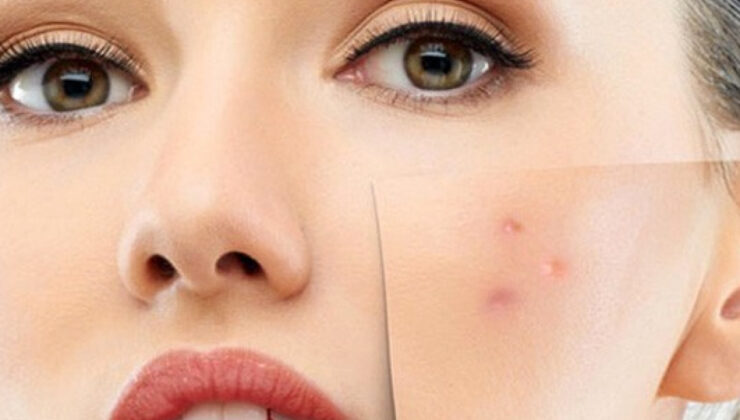 HASSAS VE ALERJİK CİLTLERE MEVSİM GEÇİŞLERİNDE DİKKAT