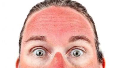 “BRONZLAŞMA ASLINDA DERİNİN KENDİNİ KORUMA MEKANİZMASIDIR”