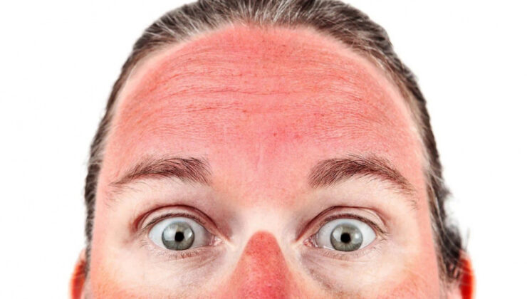 “BRONZLAŞMA ASLINDA DERİNİN KENDİNİ KORUMA MEKANİZMASIDIR”