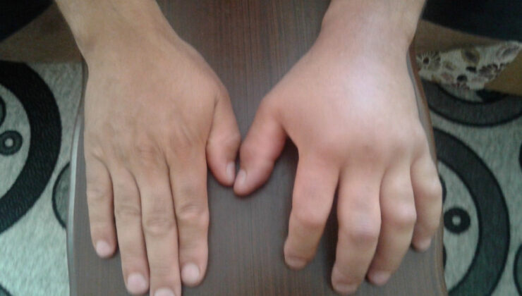 TÜRKİYE’DE TANINMAYAN HASTALIK: ALERJİ Mİ, HEREDİTER ANJİYO ÖDEM Mİ?