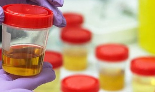 HANGİ İDRAR RENGİ HANGİ HASTALIĞIN HABERCİSİDİR?