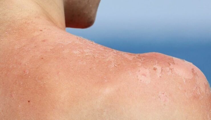 GÜNEŞLENİRKEN DİKKAT EDİN!