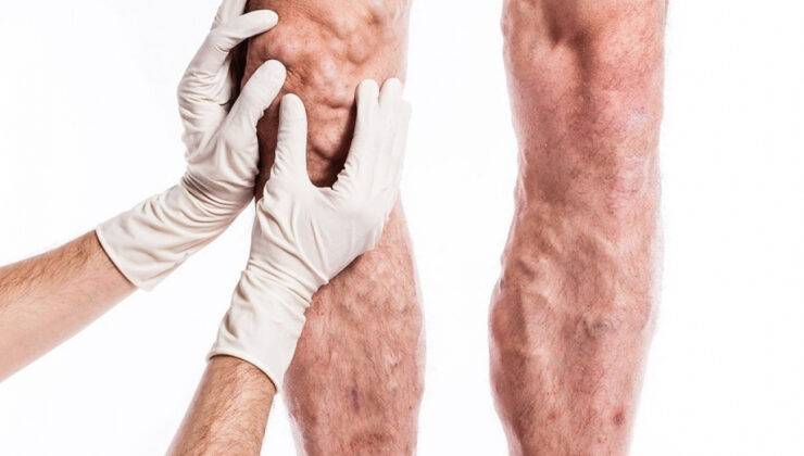 VENASEAL YÖNTEMİ İLE VARİSLERİNİZDEN AMELİYATSIZ KURTULUN