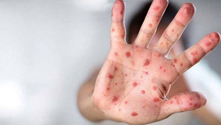 UZMANI UYARDI: MAYMUN ÇİÇEĞİ VAKALARINDA ARTIŞ BEKLENİYOR