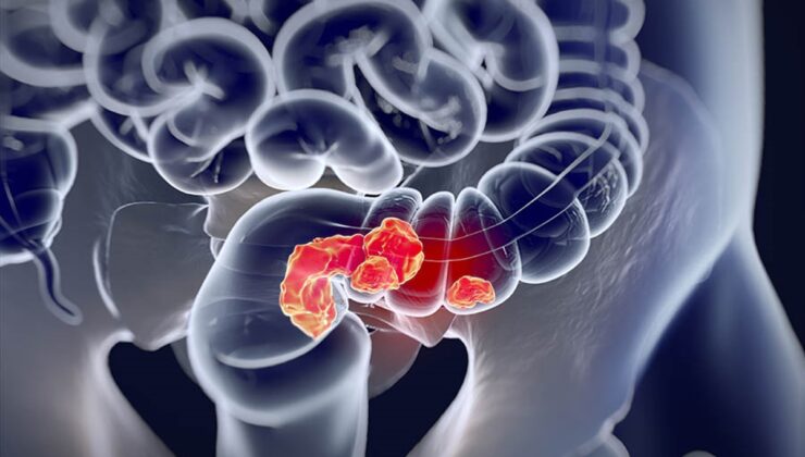 GENÇLERDE REKTUM KANSERİNE DİKKAT!