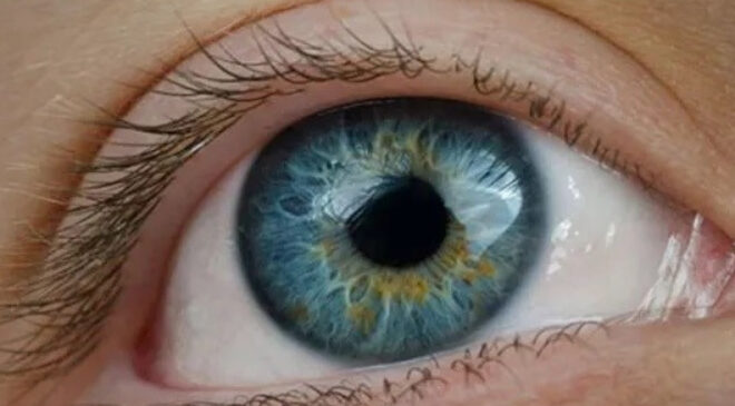 ‘KÖRLÜK NEDENLERİ ARASINDA İLK SIRADA, DÜNYADA TEK TEDAVİSİ AMELİYAT’