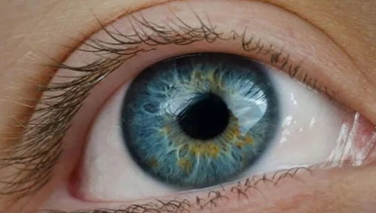 ‘KÖRLÜK NEDENLERİ ARASINDA İLK SIRADA, DÜNYADA TEK TEDAVİSİ AMELİYAT’