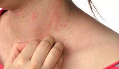 UYUZ HASTALIĞININ NEDENİ HİJYEN EKSİKLİĞİ