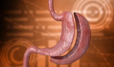 TÜP MİDE AMELİYATI OLANLAR DİKKAT, UZMANI UYARDI