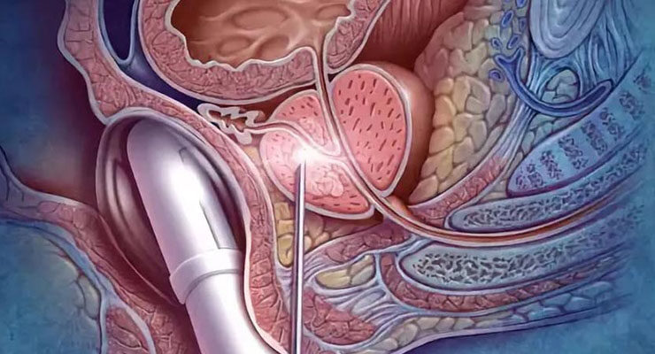 “65 YAŞ ÜSTÜNDEKİ KİŞİLERDE PROSTAT KANSERİ RİSKİ YÜKSEK”