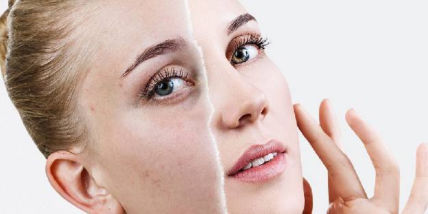 LEKE TEDAVİLERİ UZUN SOLUKLUDUR VE SABIR GEREKTİRİR