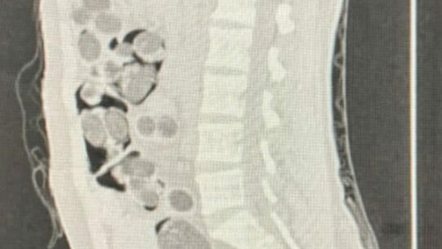 Yabancı uyruklu yolcunun midesinden 219 paket uyuşturucu çıktı